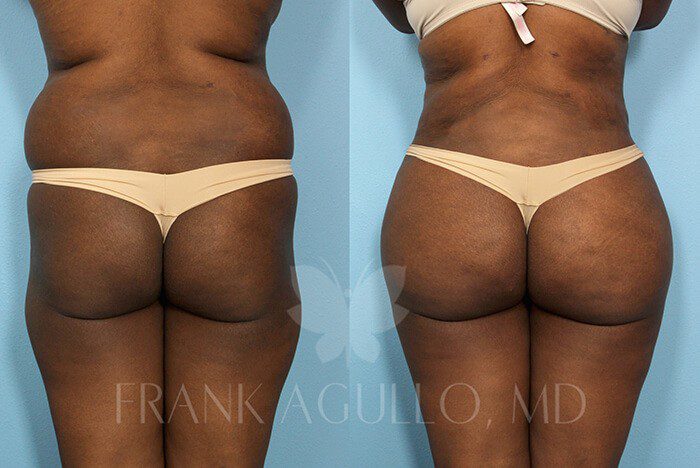 Brazilian Butt Lift Before and After 7