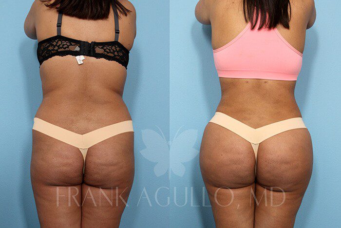 Before & After Photos  Brazilian Butt Lift Patient 51 - Frank Agullo, MD