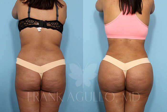 Brazilian Butt Lift Before and After 6