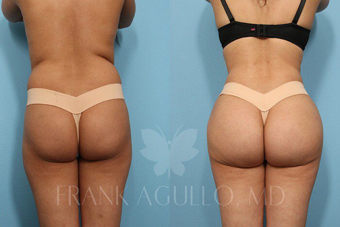 Brazilian Butt Lift Before and After 8