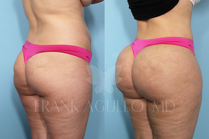 Brazilian Butt Lift Before and After 8