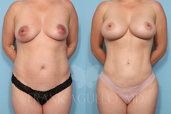Brazilian Butt Lift Before and After 15