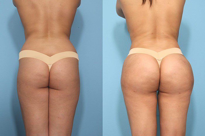 Brazilian Butt Lift Before and After 1