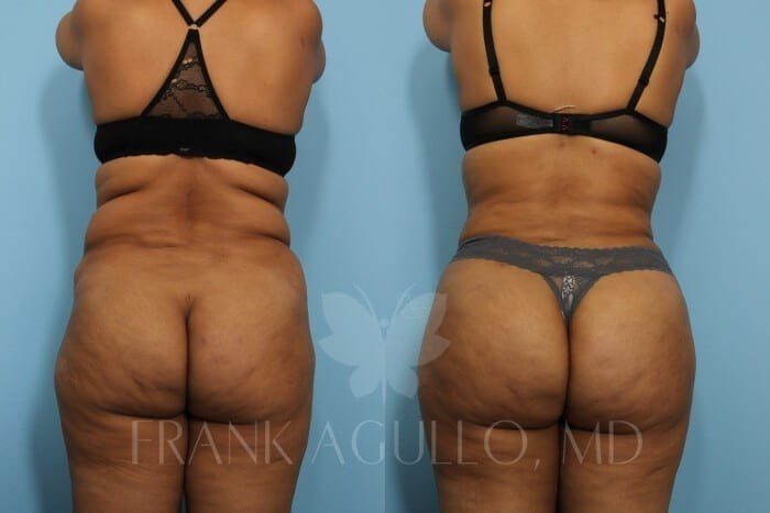 Before & After Photos  Brazilian Butt Lift 42 - Frank Agullo, MD
