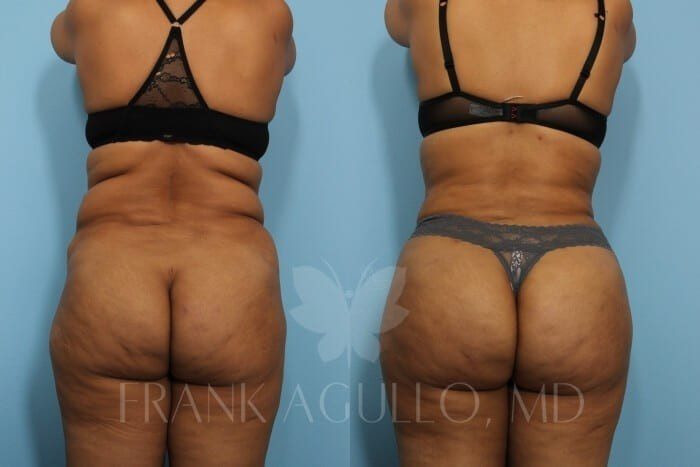 Brazilian Butt Lift Before and After 20