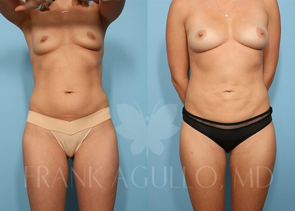 Breast Augmentation with Fat Injection Before and After 8