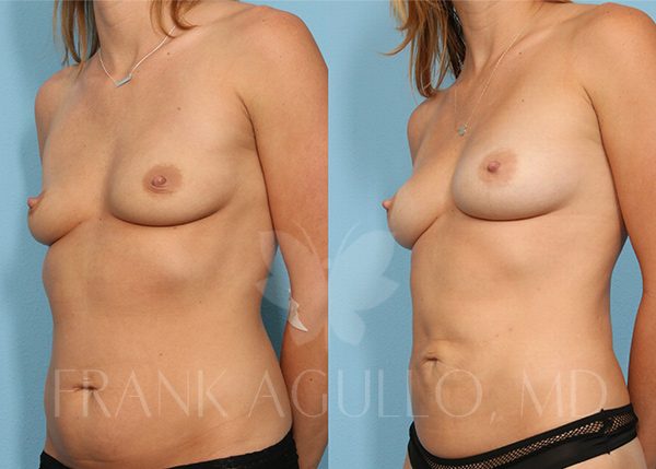 Breast Augmentation with Fat Injection Before and After 2