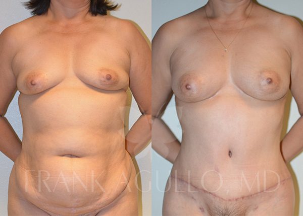 Breast Augmentation with Fat Injection Before and After 6