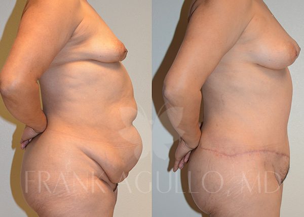 Breast Augmentation with Fat Injection Before and After 2