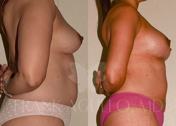 Breast Augmentation with Fat Injection Before and After 2