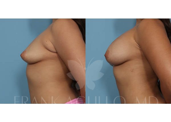 Breast Augmentation with Fat Injection Before and After 2