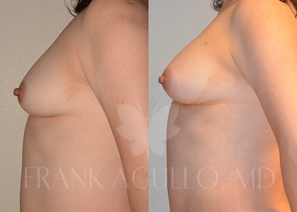 Breast Augmentation with Fat Injection Before and After 5