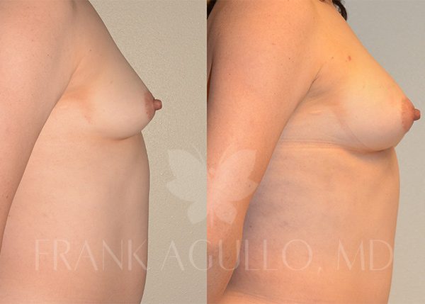 Breast Augmentation with Fat Injection Before and After 3