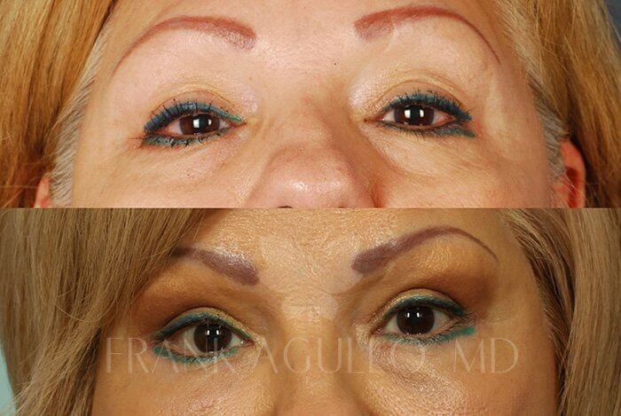 Blepharoplasty Before and After 7