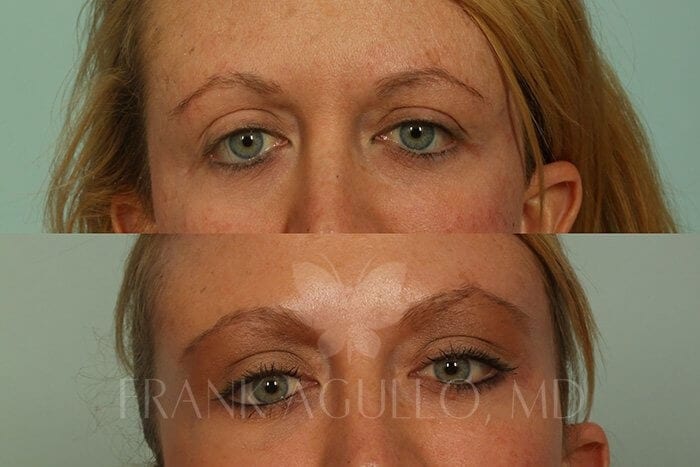 Blepharoplasty Before and After 6