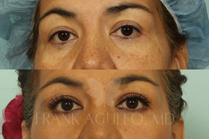 Blepharoplasty Before and After 5