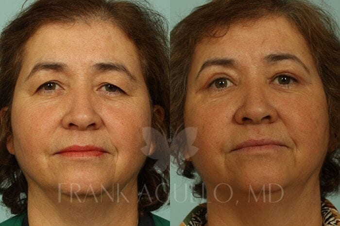 Blepharoplasty Before and After 4