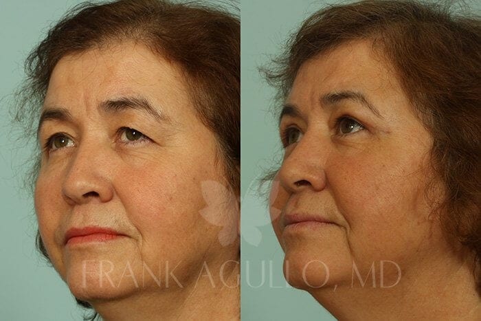 Blepharoplasty Before and After 2