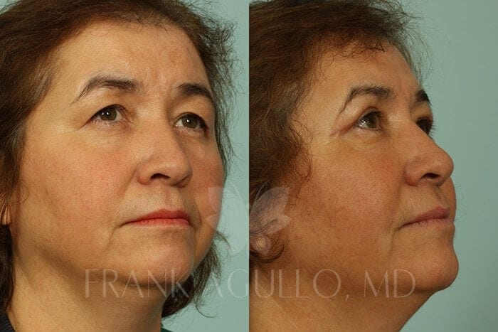 Blepharoplasty Before and After 3