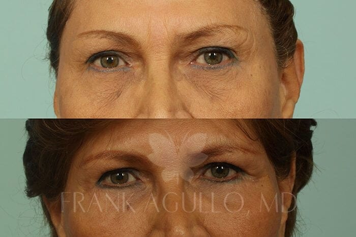 Blepharoplasty Before and After 3