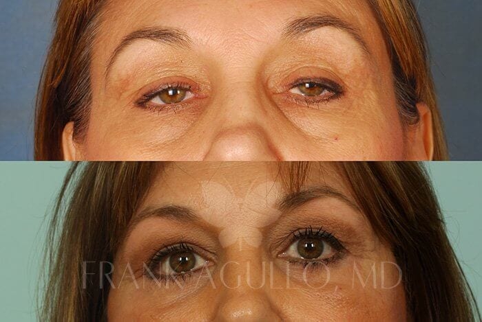 Blepharoplasty Before and After 2