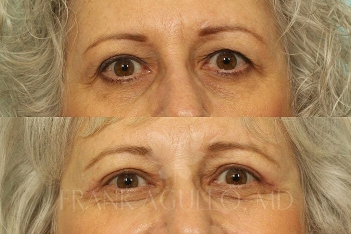 Blepharoplasty Before and After 1