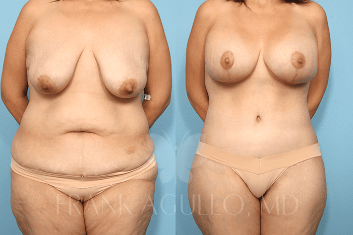 Body Contouring Before and After 1