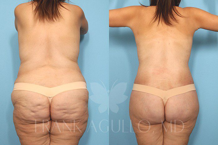 Body Contouring Before and After 3