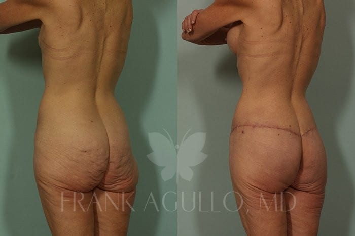 Body Contouring Before and After 2