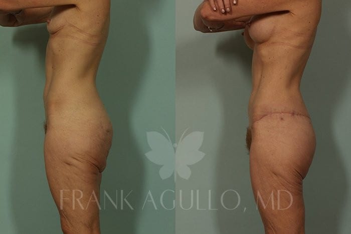 Before & After Photos  Body Contouring 1 - Frank Agullo, MD