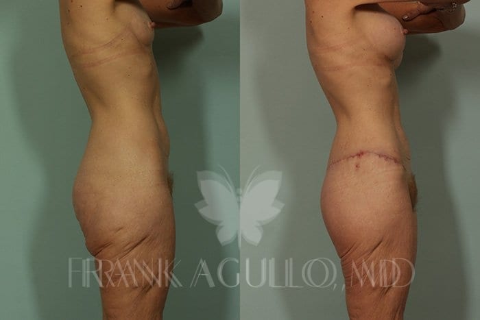 Body Contouring Before and After 4