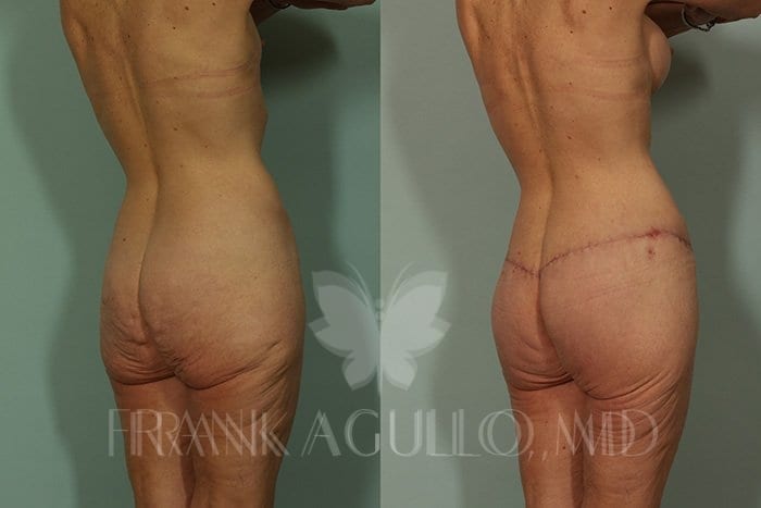 Body Contouring Before and After 5