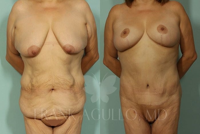 Body Contouring Before and After 6