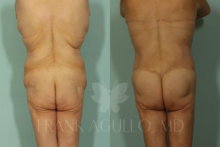 Body Contouring Before and After 5