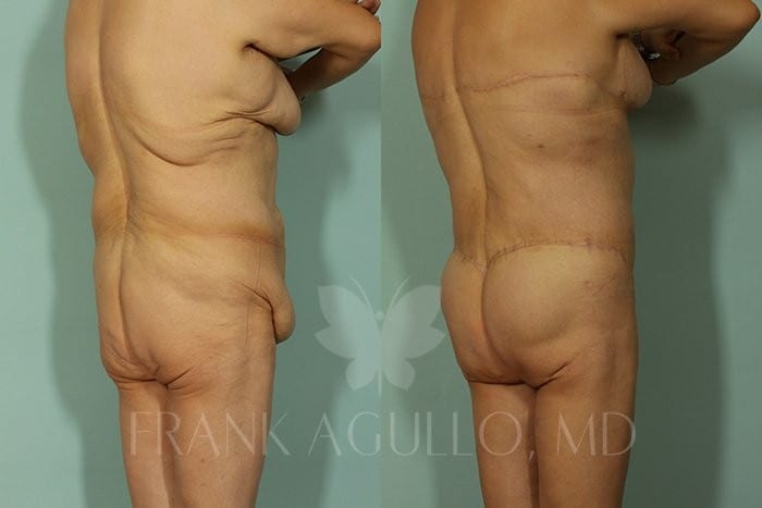 Body Contouring Before and After 4