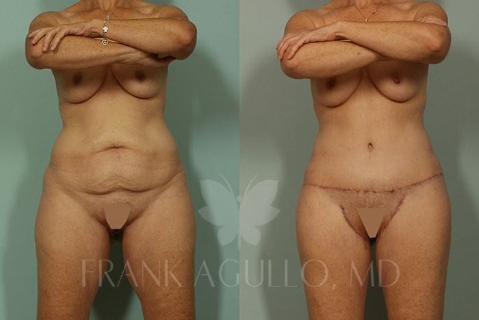 Body Contouring Before and After 5