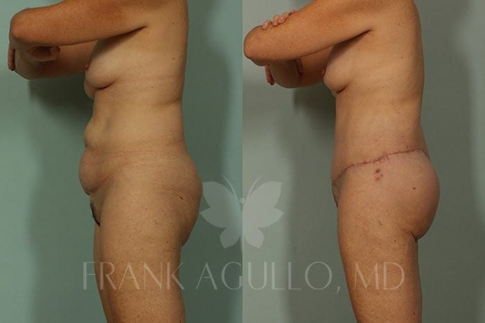 Body Contouring Before and After 4