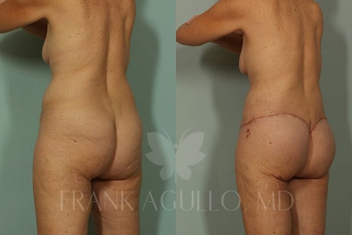 Body Contouring Before and After 5