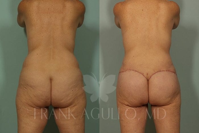Body Contouring Before and After 6