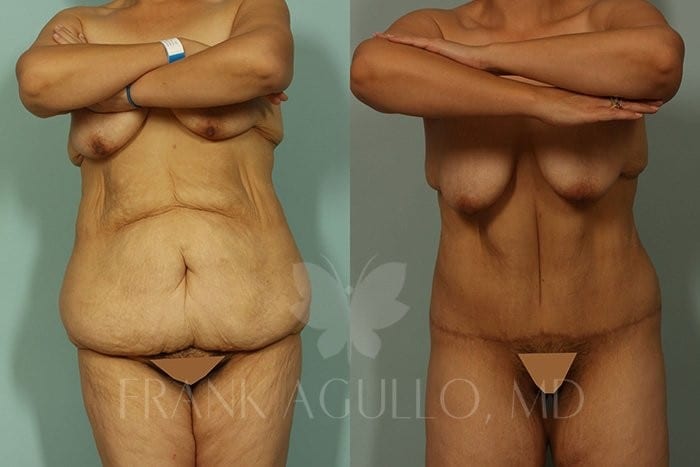 Body Contouring Before and After 4