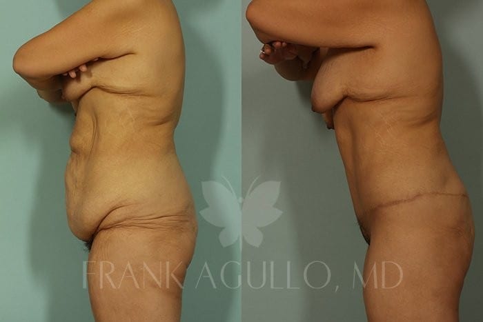 Body Contouring Before and After 3
