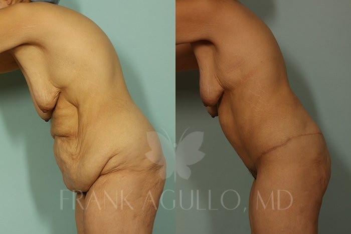 Body Contouring Before and After 2