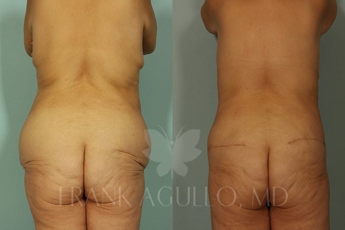 Body Contouring Before and After 5