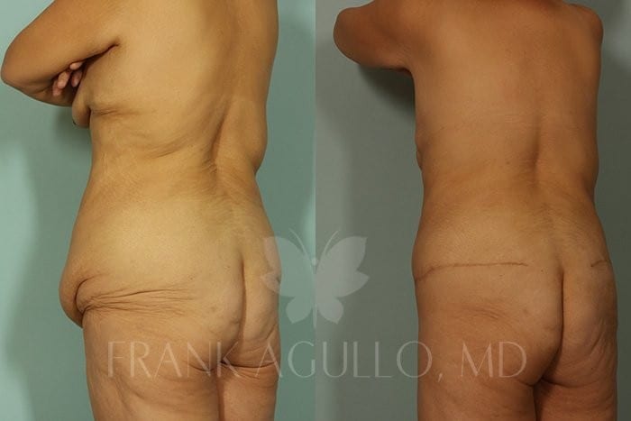 Body Contouring Before and After 4