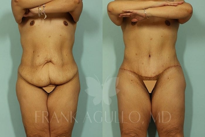 Body Contouring Before and After 3