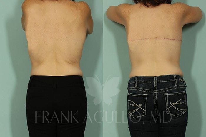 Body Contouring Before and After 4