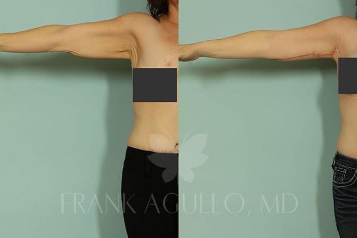 Body Contouring Before and After 6