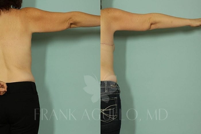 Body Contouring Before and After 8