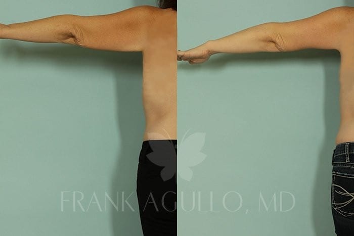 Body Contouring Before and After 9