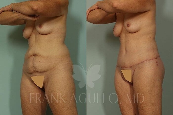 Body Lift Before and After 2
